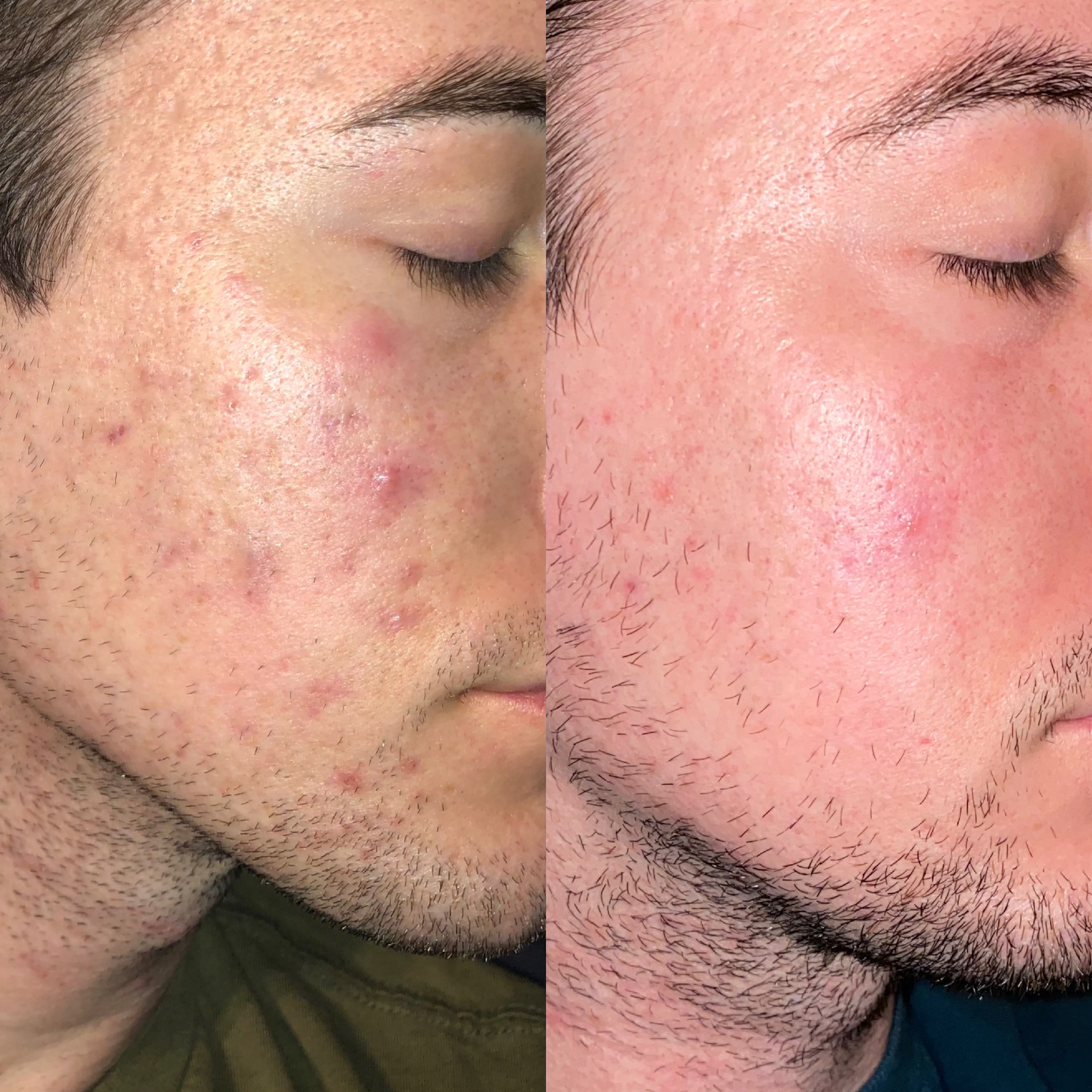 Acne treatment before and after, 1 year of sessions 6 weeks apart