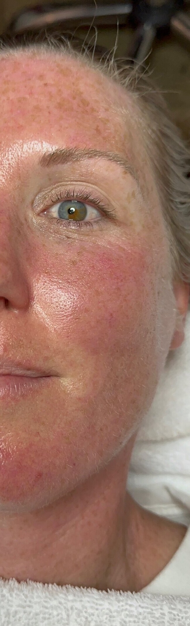 After Diamond Tome HydroPlus treatment