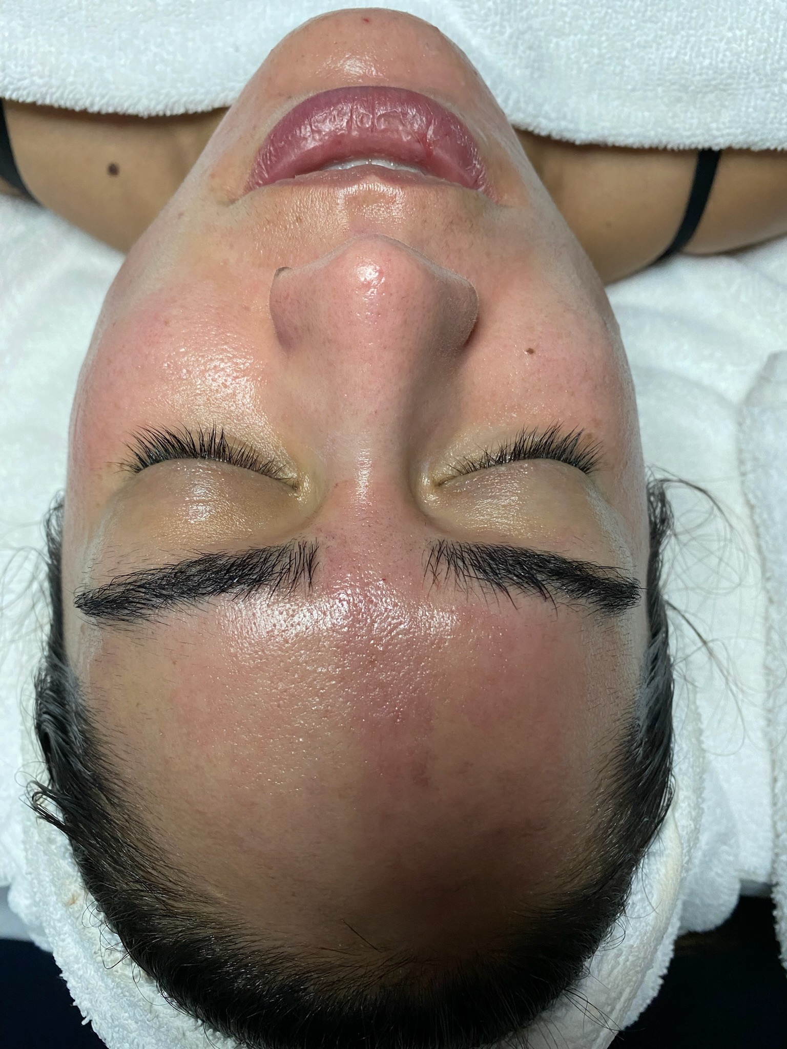 After Diamond Tome HydroPlus treatment and extractions