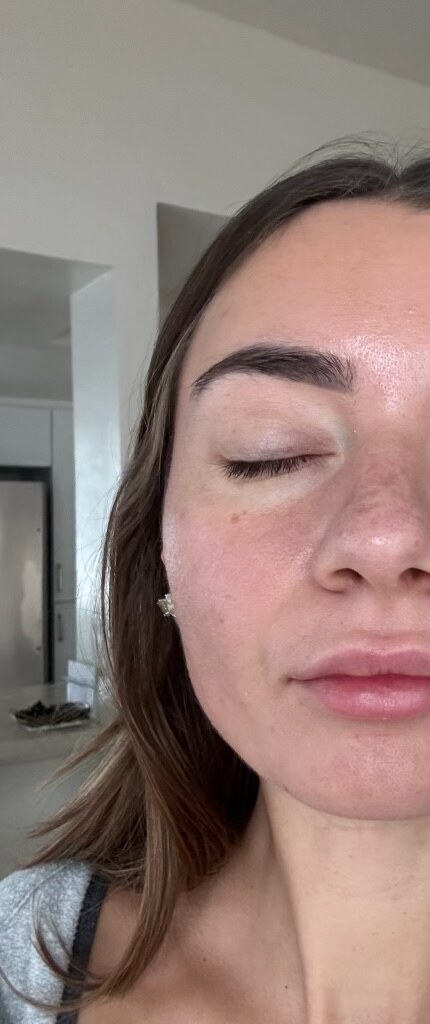 After Lighting Peel treatment