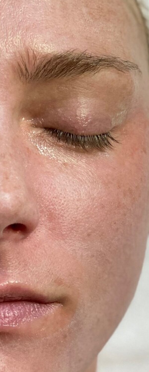 Before Blue Peel treatment