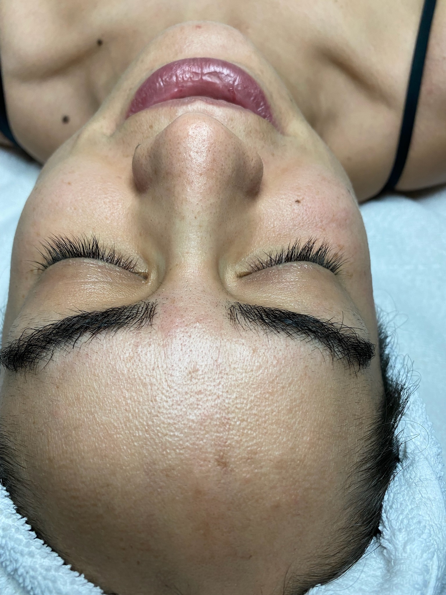 Before Diamond Tome HydroPlus treatment