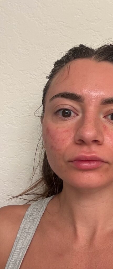 Before Lighting Peel treatment