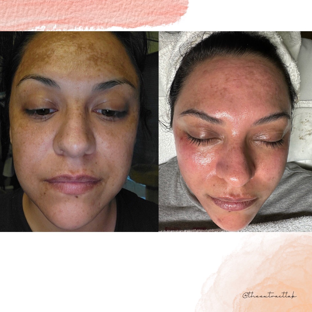 Melasma and pigmentation before and after