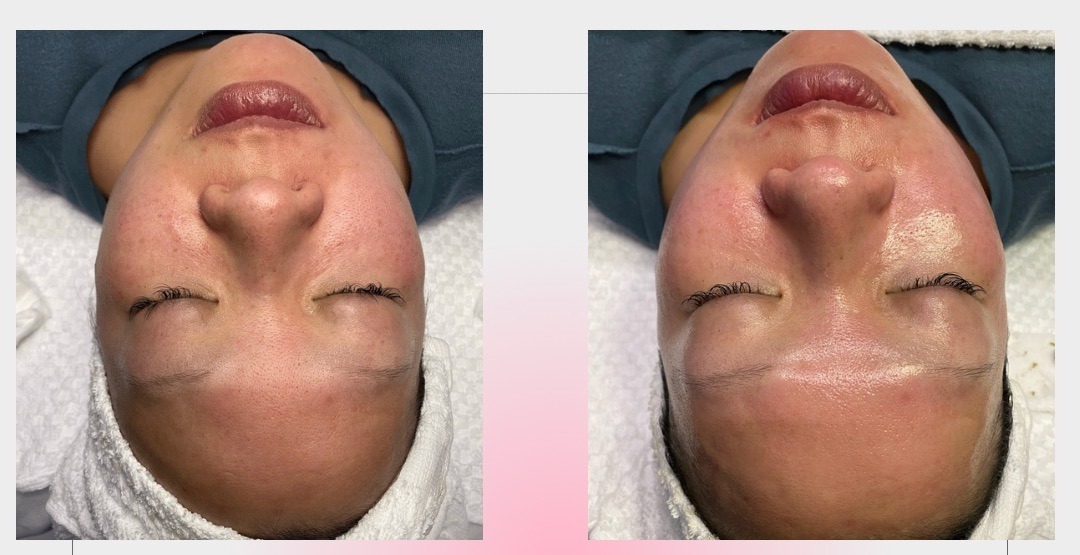 Microdermabrasion before and after with extractions